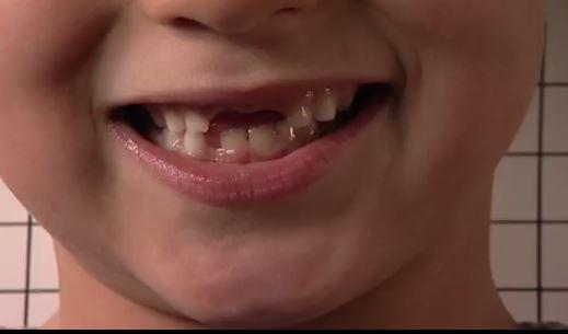 Bilde av gutt med manglende tenner