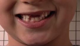 Bilde av gutt med manglende tenner